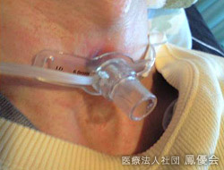 気管切開部の処置 イメージ1